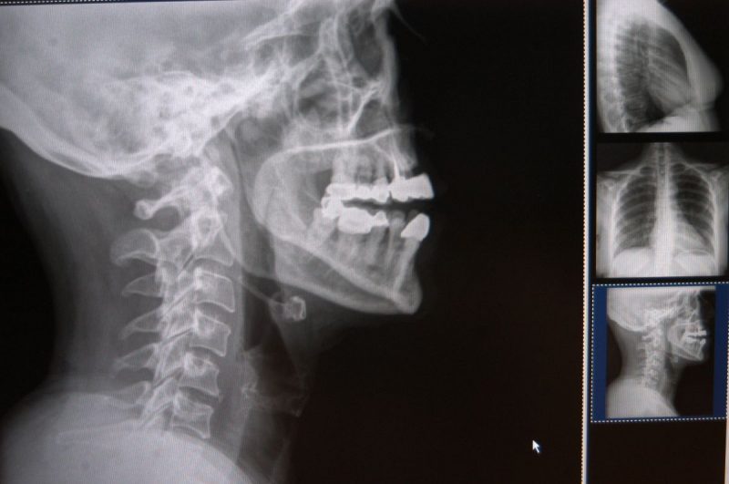 radiografía de problemas de columna que afectan la postura