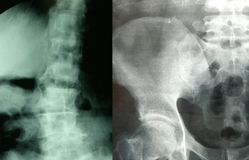 radiografia de un hueso con osteoporosis