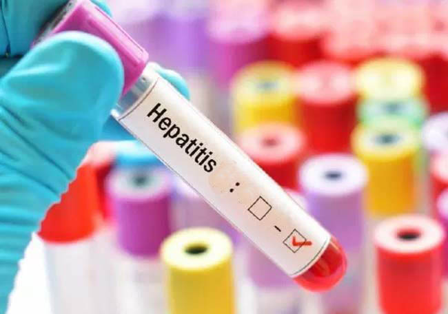 hepatitis