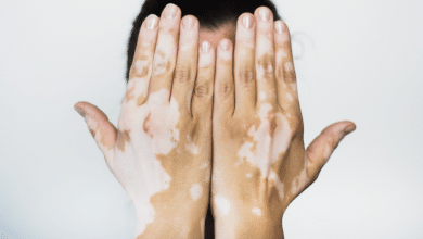 vitiligo