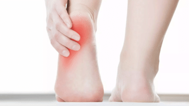 fascitis plantar