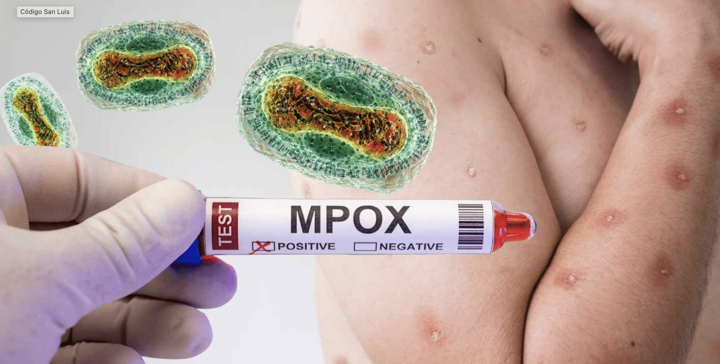 virus mpox