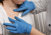 sarampión enferemedades salud vida sana