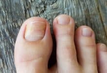 onicomicosis