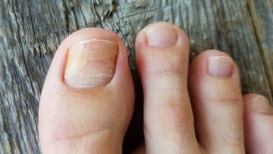 onicomicosis