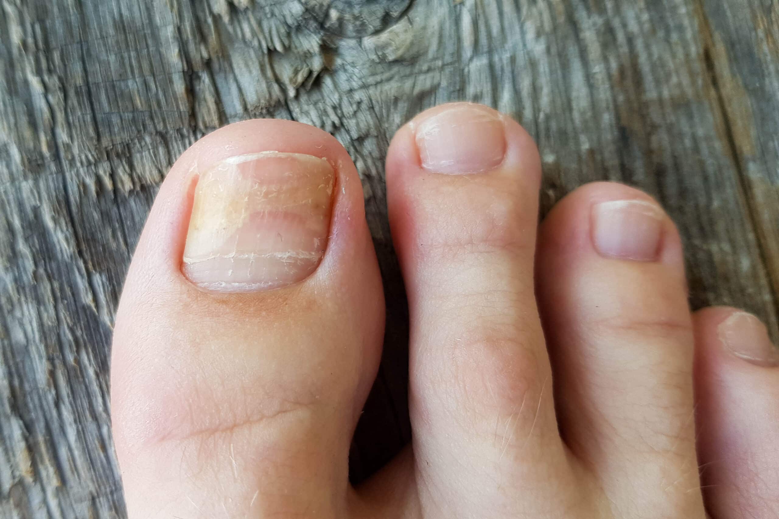 onicomicosis